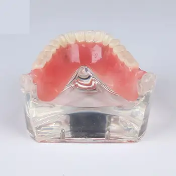 Dantų Dantų Tyrimas, Mokyti Modelis Overdenture Prastesnės 4 Implantas Demo Modelis